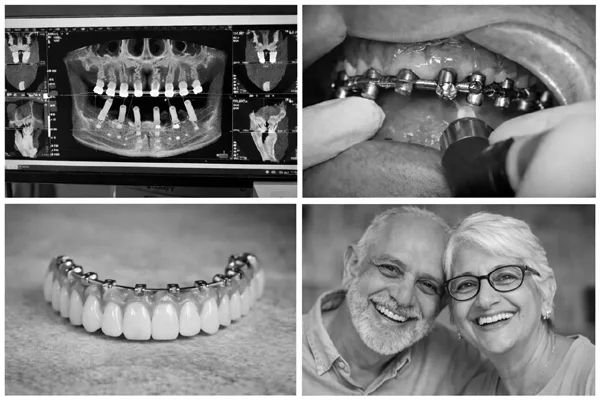 Full Mouth Dental Implant