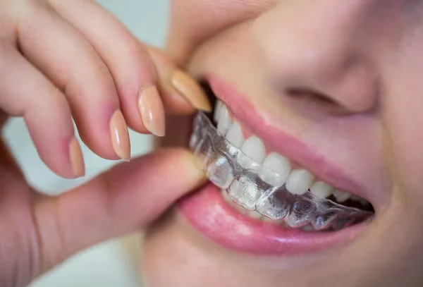 Invisible Braces