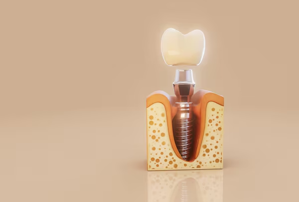 Dental Implants Faridabad