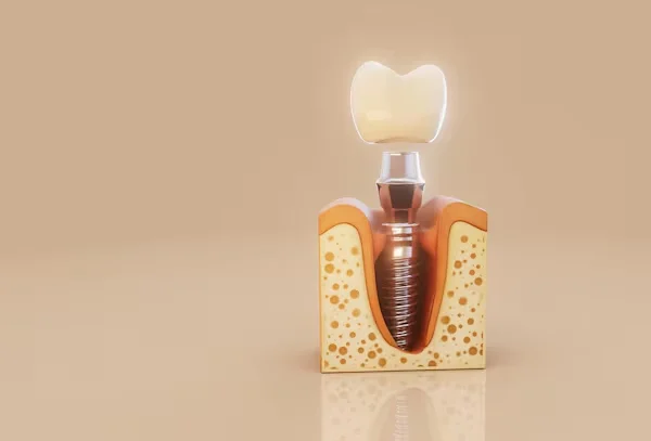 Dental Implants Faridabad