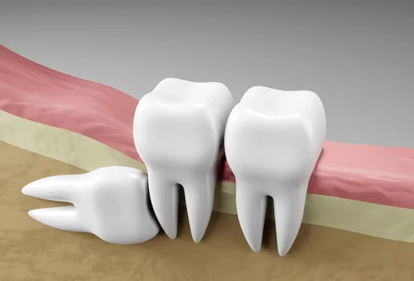 Wisdom Teeth Problems