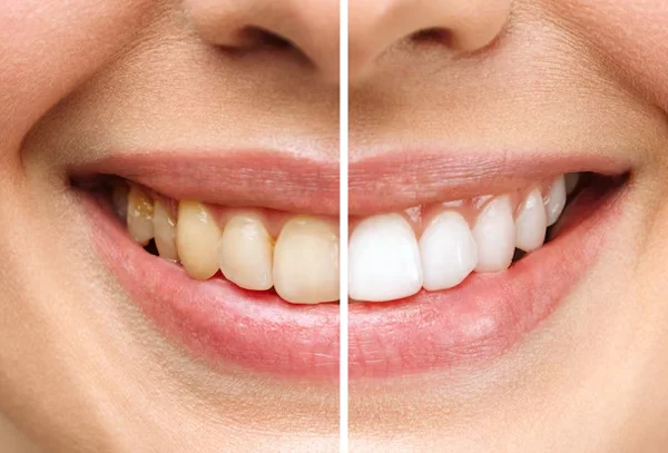 Tooth Whitening