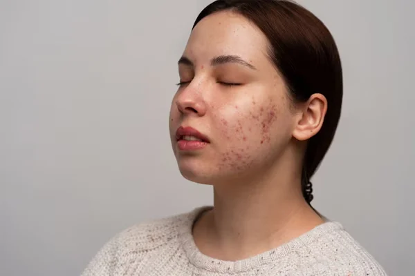 Scar Removal