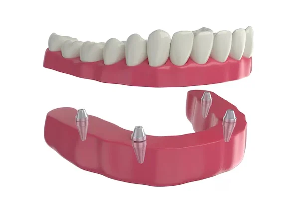 All on Four Implants